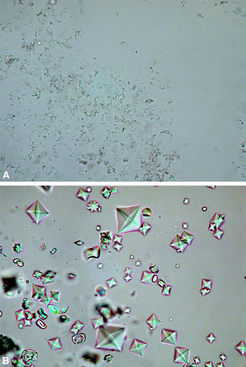 calcium oxalate crystals in urine