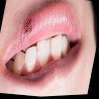 Oral Cancer - Minerva Robo3 project thumbnail