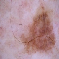 Melanoma skin cancer project thumbnail