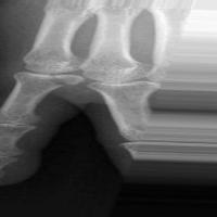 bone fracture project thumbnail