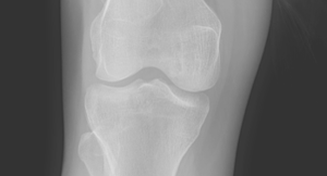 Digital Knee X-ray Object Detection Model by school