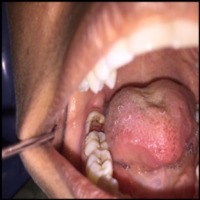 oral detection project thumbnail