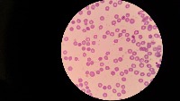 malaria infection project thumbnail