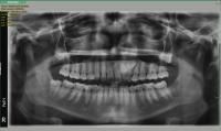 Impacted canine project thumbnail