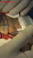 hair-transplant-needle project thumbnail