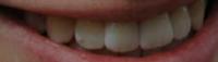 teeth project thumbnail