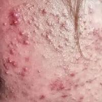 acne_detection project thumbnail