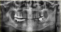 dental_yolo_v8 project thumbnail