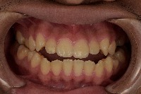 Gingivitis Detection project thumbnail