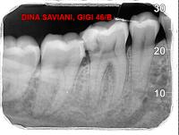 Periodontal boneloss project thumbnail