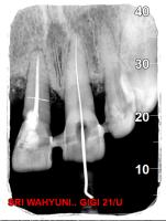 Periodontal boneloss v2 project thumbnail