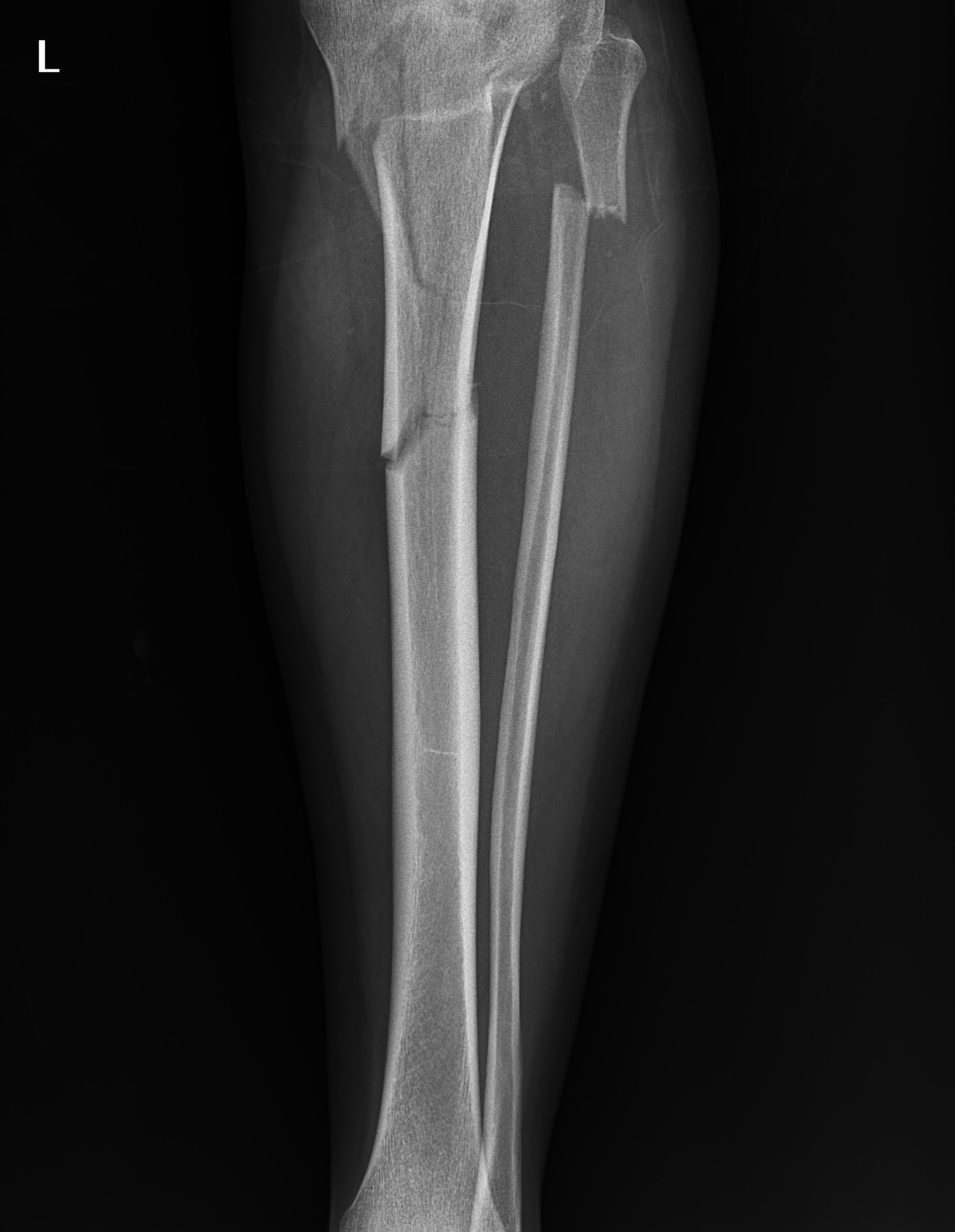 tibia fracture annotate Object Detection Dataset by Gopalas Workspace