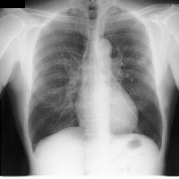lung_cancer project thumbnail