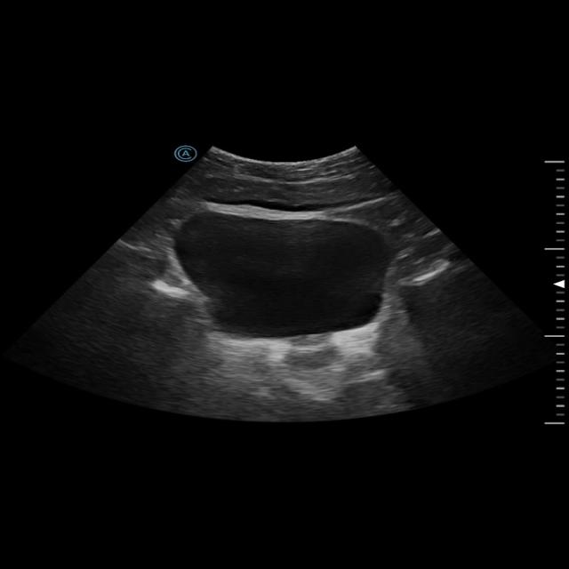 bladder Instance Segmentation Dataset by Daniel
