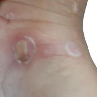 scabies valid project thumbnail