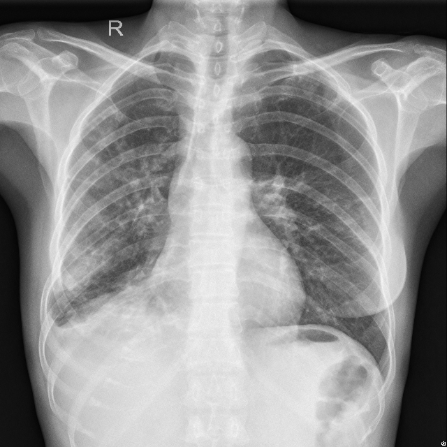 yolo_lung Object Detection Dataset and Pre-Trained Model by Basak