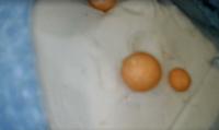 Herniated Disc + Vertebral Tumor project thumbnail