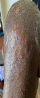 Folliculitis- Final project thumbnail