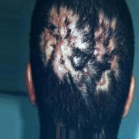 Hair Disease Detection project thumbnail