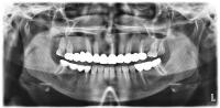 DentSeg3_4Class_Only_PL project thumbnail