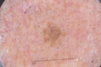 Melanoma project thumbnail