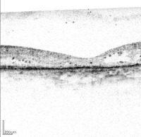 oct_detection project thumbnail