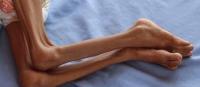 Malnutrition Detection project thumbnail
