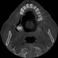 Tooth (tooth-qonnl) - Roboflow Universe