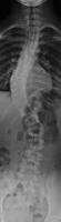 scoliosis identification project thumbnail
