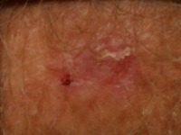 Skin_Cancer project thumbnail
