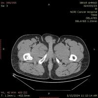 Bladder Cancer MRI project thumbnail