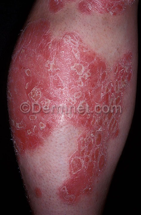 Psoriasis BSA Labeling Instance Segmentation Dataset by Csarte workspace