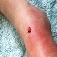 Wound new project thumbnail