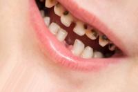 caries project thumbnail