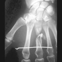 Fracture Classifier project thumbnail