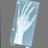 Fracture Detector project thumbnail