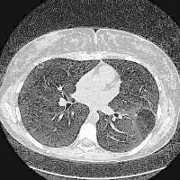 lung nodule instance project thumbnail