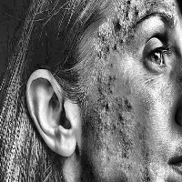 copycat_acne project thumbnail