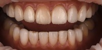teeth project thumbnail