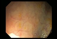 colonoscopy Object Detection Dataset by colonoscopy
