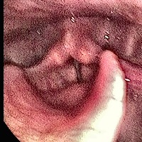 vocalcords_classification project thumbnail