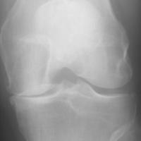 Knee osteoarthritis  project thumbnail