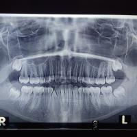 dental xray detection  project thumbnail