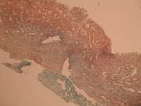 à vérifier (severe et nonSevere) project thumbnail