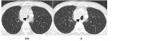 Tracheal Cancer project thumbnail