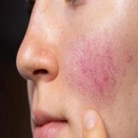 Acne_dataset project thumbnail