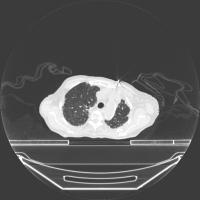 Emphysema project thumbnail
