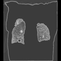 COPD project thumbnail
