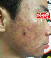 Acne04 project thumbnail