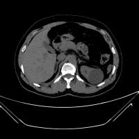 kidney failure project thumbnail